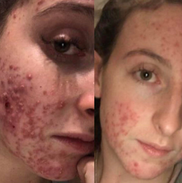 Hormonal Acne 3 Week Results Reviews And Results Bangn Body 